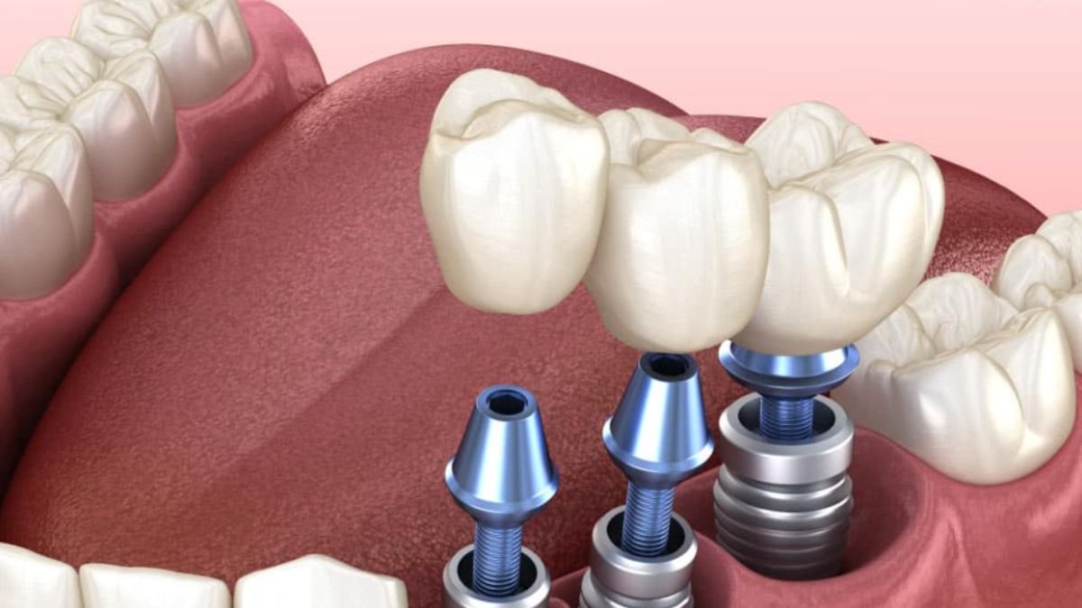 Innovations in Tooth Replacement